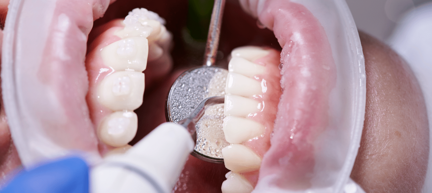 dental cleaning in League City, Texas